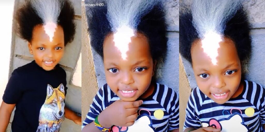 little-girl-with-unique-shiny-birthmark-and-white-frontal-hairs-causes-a-stir-(video)