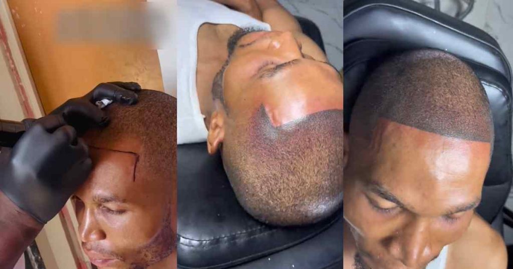 “what-if-he-goes-b@ld-in-old-age?”-–-man-takes-drast!c-measure-to-define-hairline,-gets-permanent-tattoo-(video)
