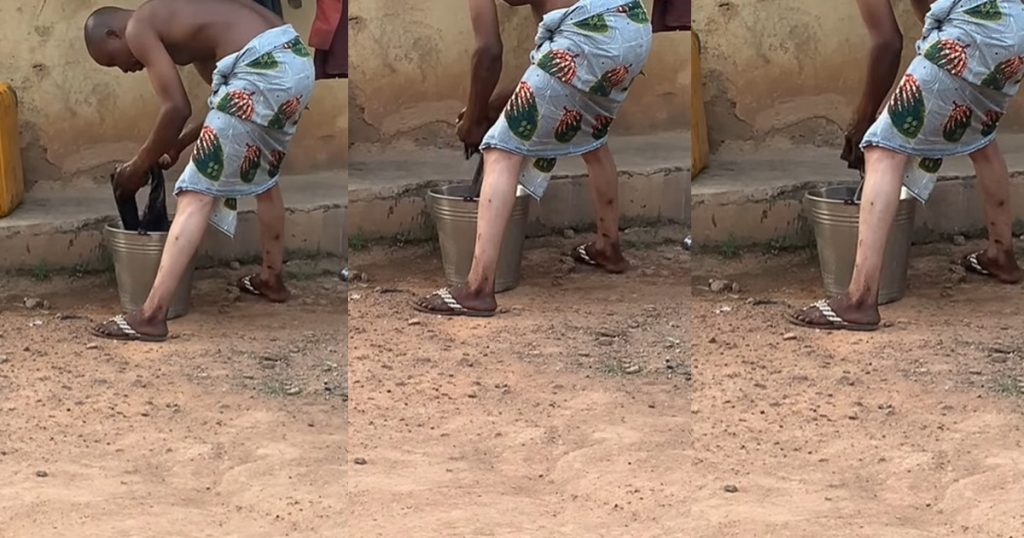 man’s-leg-undergoes-stunning-transformation-following-blɘaching-cream-use-(watch)