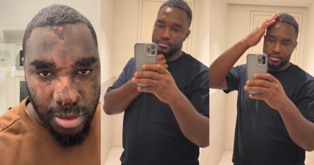 “13-months-recovery”-–-man-shares-remarkable-facial-recovery-after-surviving-pressure-cooker-expl0sion-(watch)